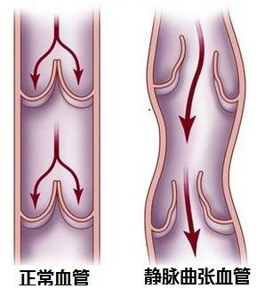 得了下肢靜脈曲張,還在用「熱水泡腳」,小心越來越嚴重!