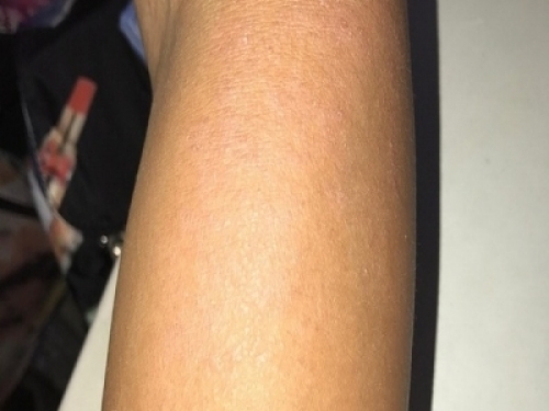 你可能也有光过敏，防晒再不做皮肤该要小心!