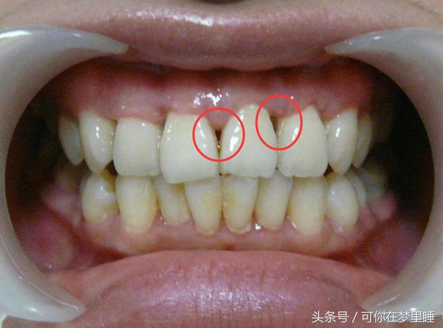 有些人会突然发现自己的牙齿变长,牙缝变大,或感觉齿根开始暴露,牙齿