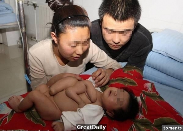 這名嬰兒生下來後胸前竟有個「無腦死嬰」！焦急萬分的父母淚流滿面的求醫後，沒想到最後竟然是這樣的結局...！