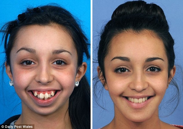 这个女孩从小被笑「超丑一定没人要」,终於被父母「带去装牙套」却被
