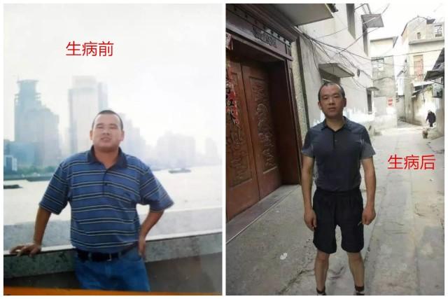 得糖尿病後藥不能停?糖友真實案例告訴你最佳停藥時間