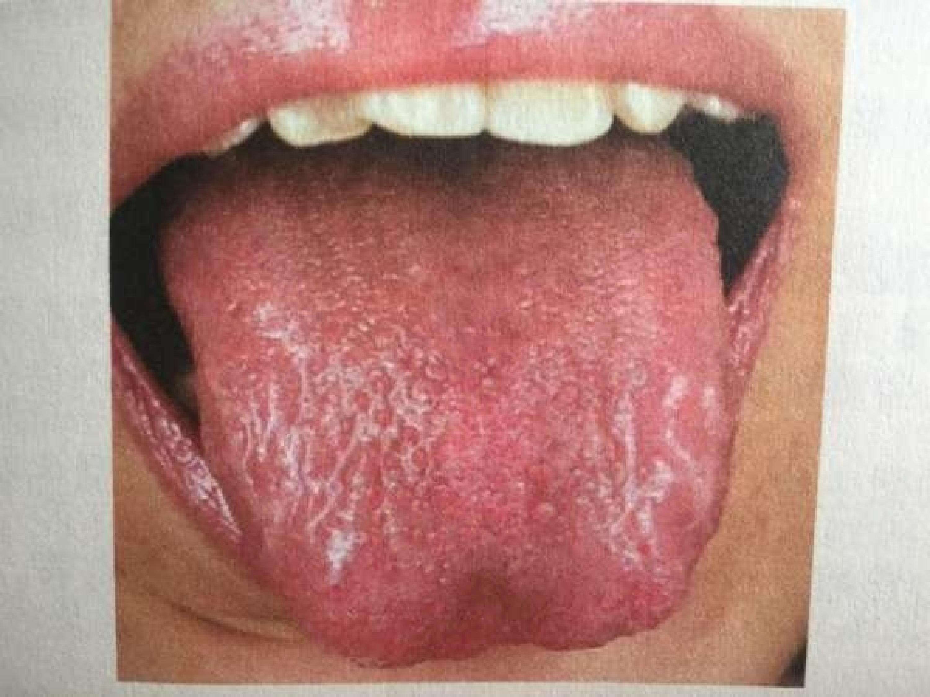 判断阴虚火旺的标准:舌体通红,极少舌苔.