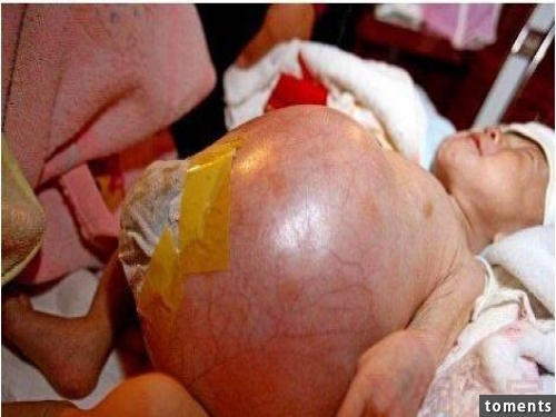 這名6個月大的男嬰，肚子一天天脹大如氣球！當醫生照完超音波，才發現嬰兒的肚內竟藏了一個有腳有手的胚胎......