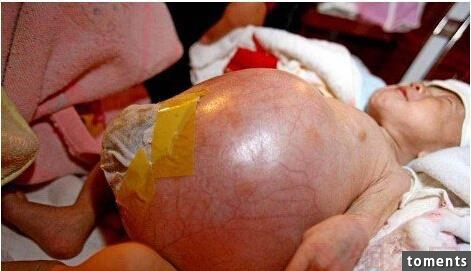 這名6個月大的男嬰，肚子一天天脹大如氣球！當醫生照完超音波，才發現嬰兒的肚內竟藏了一個有腳有手的胚胎......