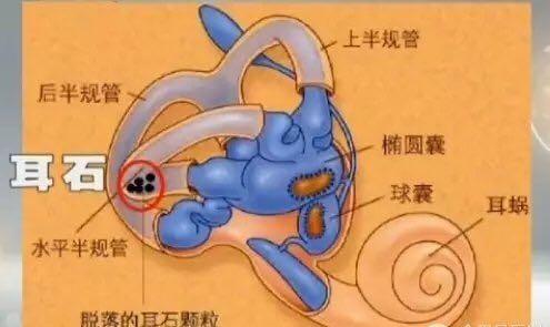 女子多年眩暈頑疾是耳朵裡「石頭」作怪!妙手「扒拉」幾下好了?