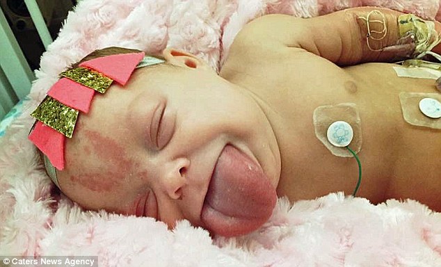 女嬰一出生「舌頭比嘴巴大2倍」差點噎死，醫生一刀割開...她「首次露笑容」現在可愛到炸！