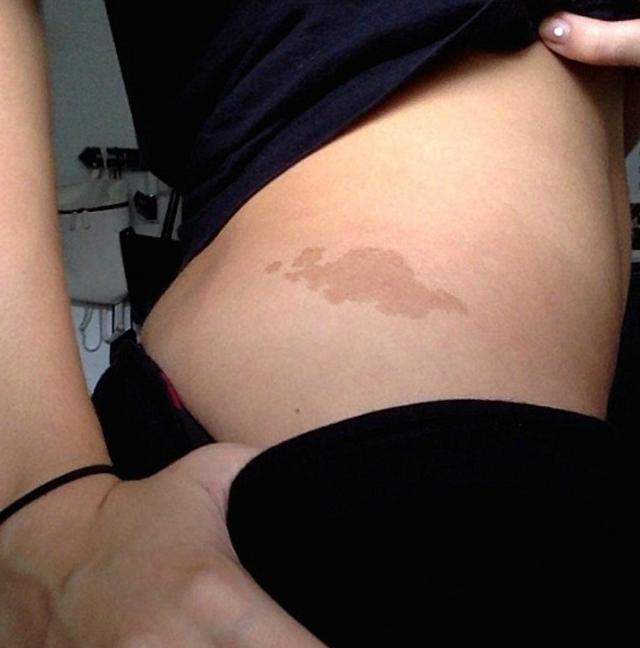 17個讓人難以置信的罕見胎記