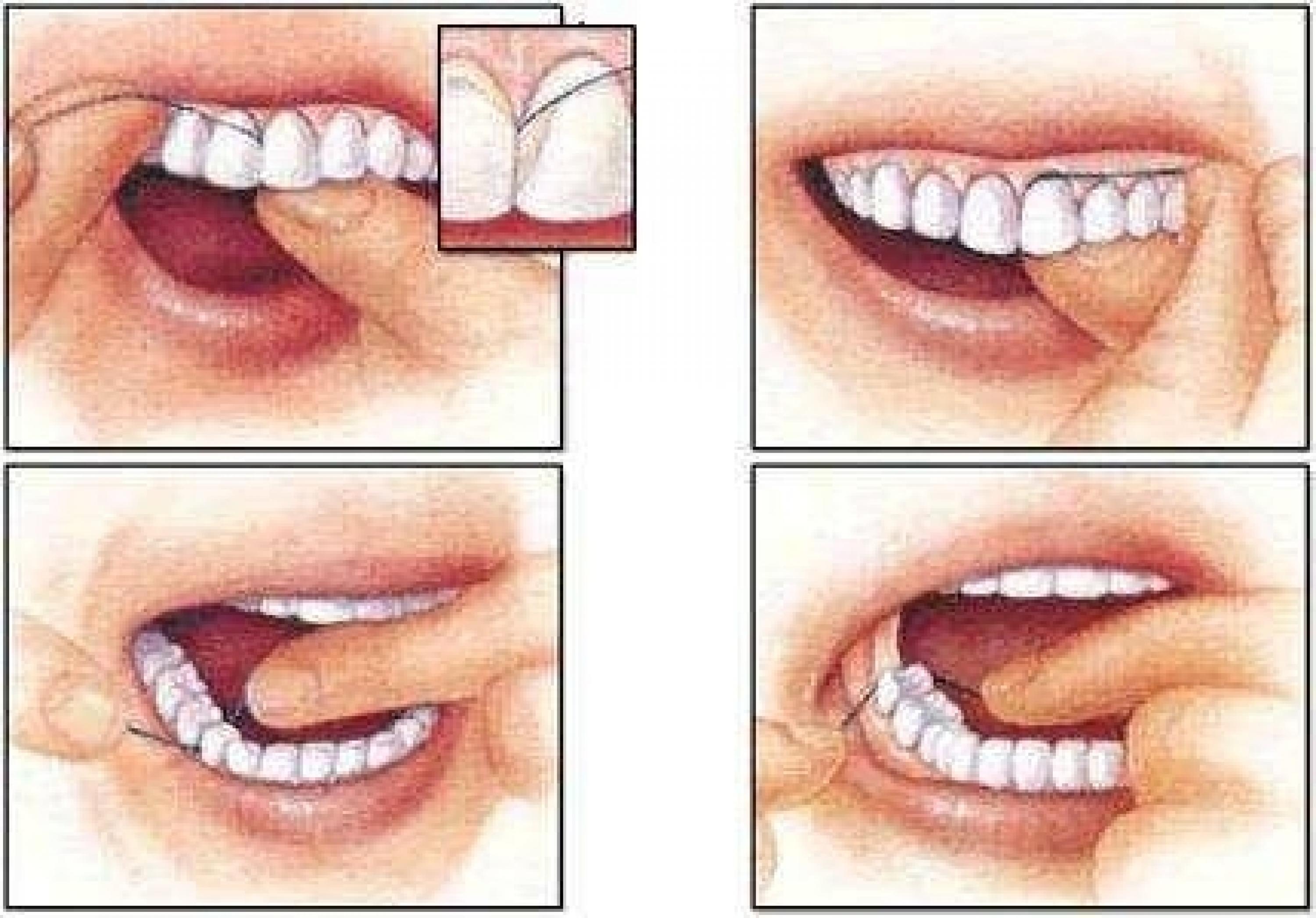 Техника чистки зубов зубной нитью