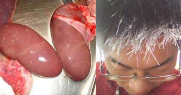 從「頭髮」就能三秒看出你的「腎臟」好不好!「少年白」原來代表著..... 看完後我整個快嚇死!