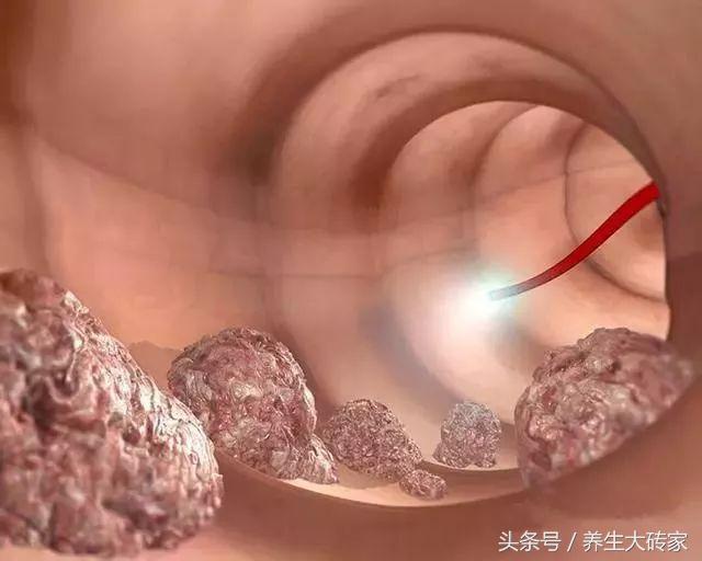 醫生提醒:有這四個症狀,可能是腸癌早期,3件事,再難也要堅持