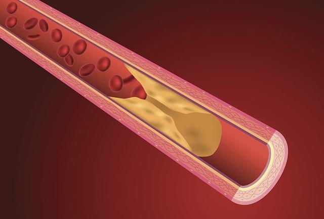 3,如果腿上的血管堵塞——动脉硬化闭塞 严重时可能导致