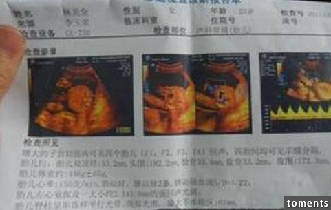懷孕3個月產檢被告知四胞胎,然而再次產檢結果讓她瞬間變了臉色