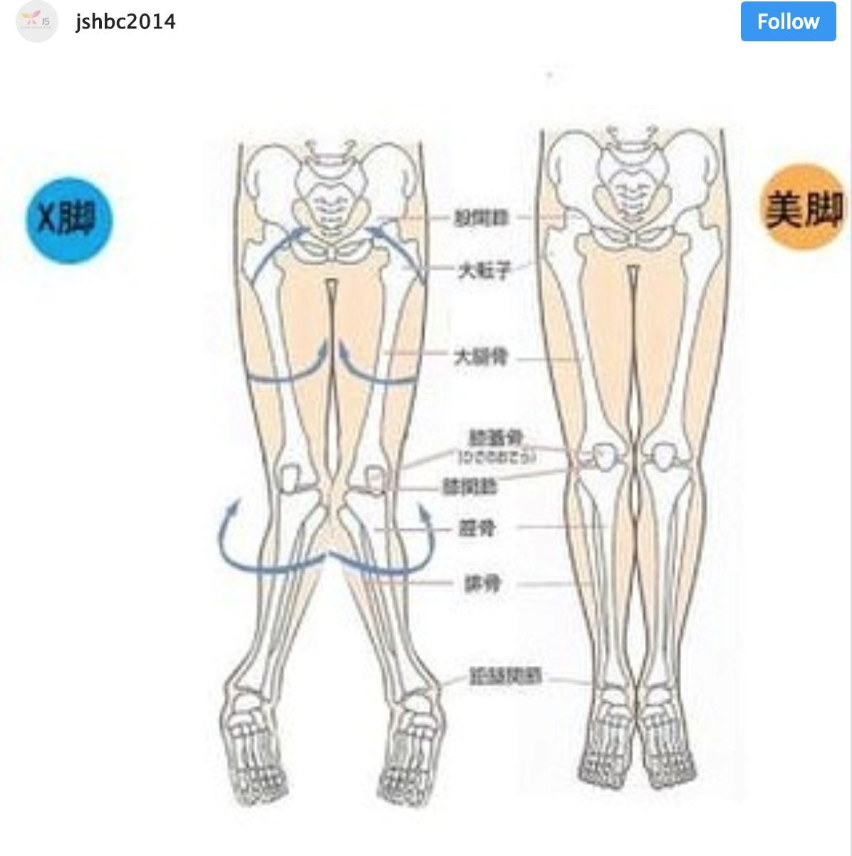 x型腿的人坐著时候习惯小腿向外翻,或者喜欢勾著椅脚坐,造成髋关节