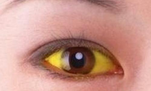 醫生警告:眼睛有這三種變化,是你的肝有問題了,現在知道還不晚