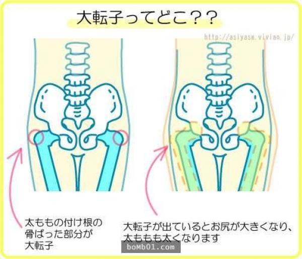 ▼看这张图就更能了解罗,骨盆变形让大转子往外凸,两侧的脂肪囤积,让