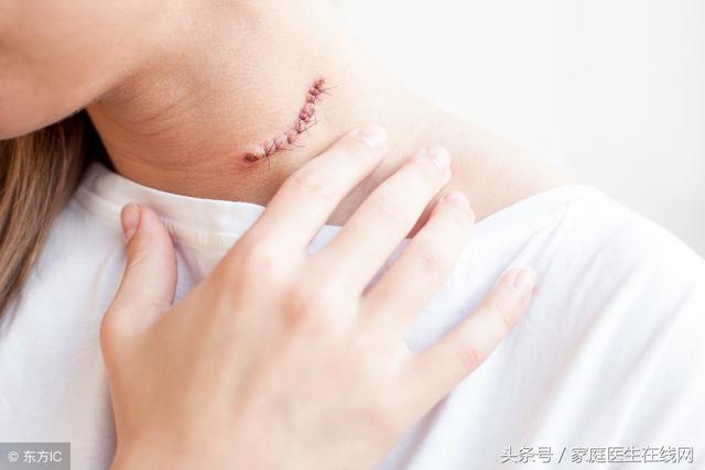 淋巴瘤早期,身體會發出2個「警告」,不要輕易無視