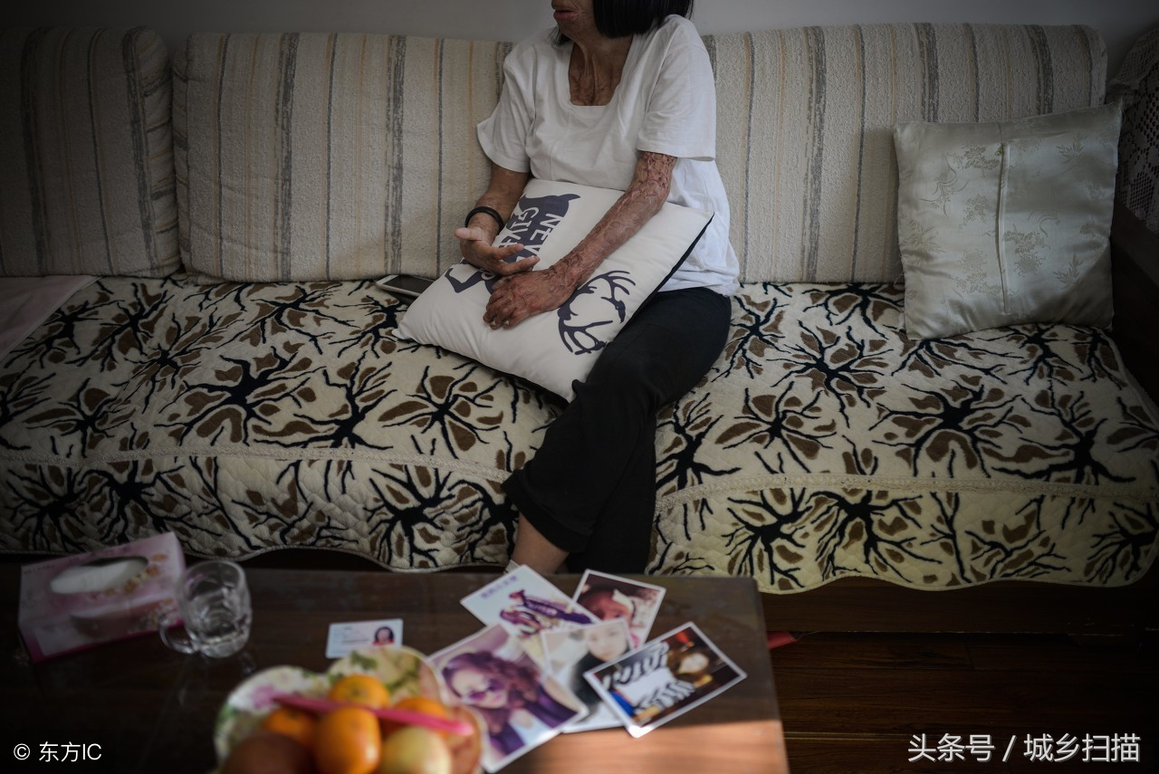 慘遭前男友潑硫酸毀容,32歲漂亮女子變「怪物」,開網絡直播賺錢-雪花新聞