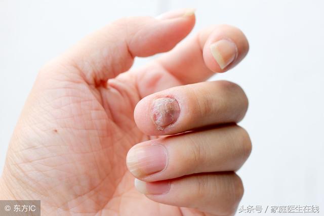 灰指甲治療要拔甲?不用怎麼麻煩,試試第一個方法就很有效