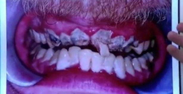 21岁男子牙齿超可怕,牙医:只能全打掉