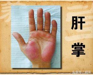 不用醫療設備檢查,只看手,我們能看出哪些疾病的端倪