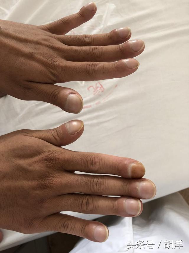 不用醫療設備檢查,只看手,我們能看出哪些疾病的端倪