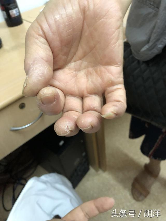 不用醫療設備檢查,只看手,我們能看出哪些疾病的端倪