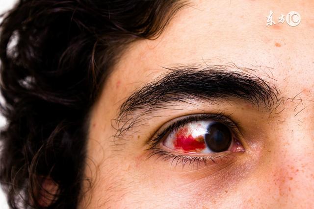 红眼病患者的饮食禁忌患了红眼病的患者在饮食方面的确