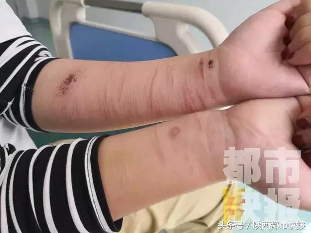 13歲女孩滿臂血痕多次自殺 「她不是怪物、只是病了……」