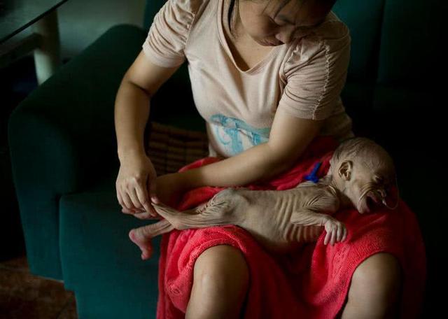 女嬰兒一歲長著長老人臉,竟因患上罕見病不長肉
