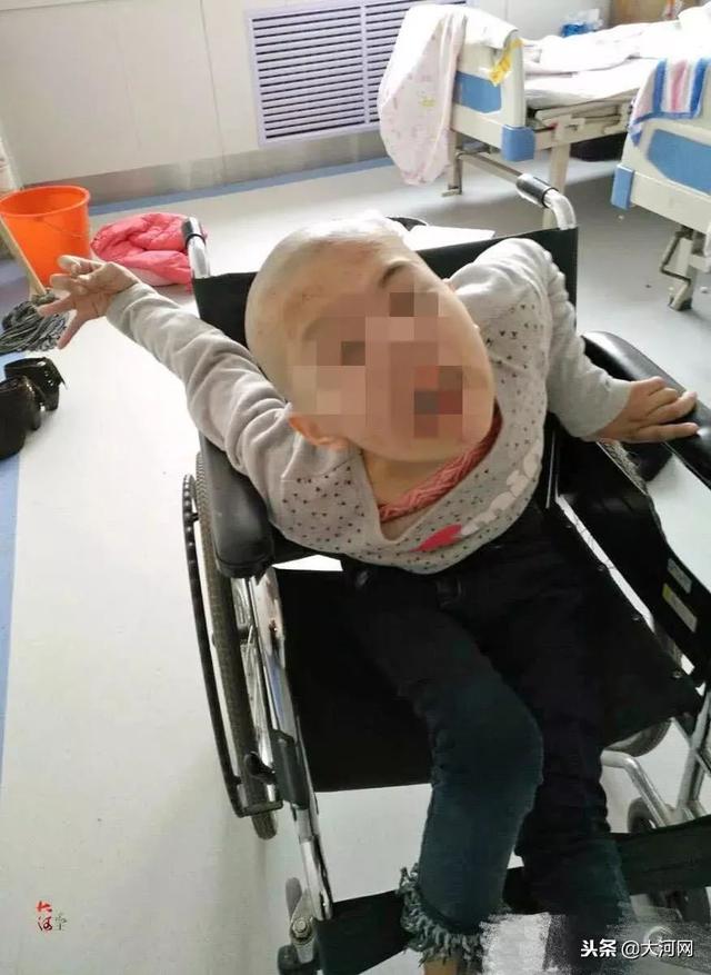 一碗山豆根水讓南陽11歲小姑娘手腳變形、嚴重腦損傷！