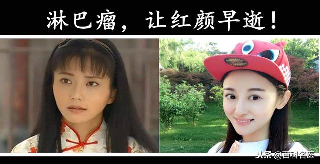 6大因素導致淋巴瘤發病率越來越高,你中了幾個?