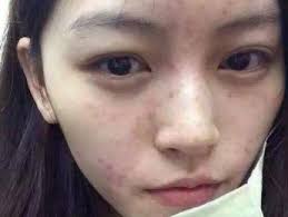 臉上長痘痘?毛囊內被蟎蟲占領了!1招除蟎,痘痘消失- 每日頭條