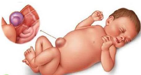 宝宝肚脐上怎麼鼓出一个大包?真是脐带没剪好吗?