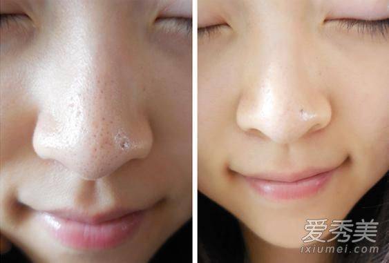 去黑頭方法:怎麼用牙膏去黑頭?