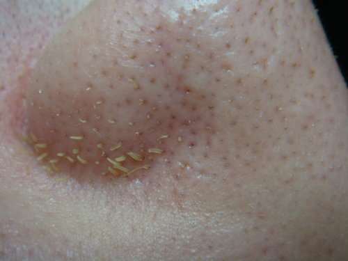 千万别再这样硬挤黑头了,90%的人都太傻了!只