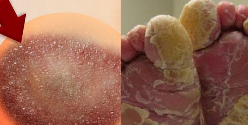 皮肤癣(ringworm)是一种真菌感染,特点是经常痒,还有红棕色环形皮疹.