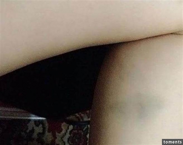 瘀青不同的顏色其實都代表不同階段。<!-- 電腦板-文章內插廣告-336X280 -->
<br><br>
<div align= 瘀青不同的顏色其實都代表不同階段。(圖/商都網)