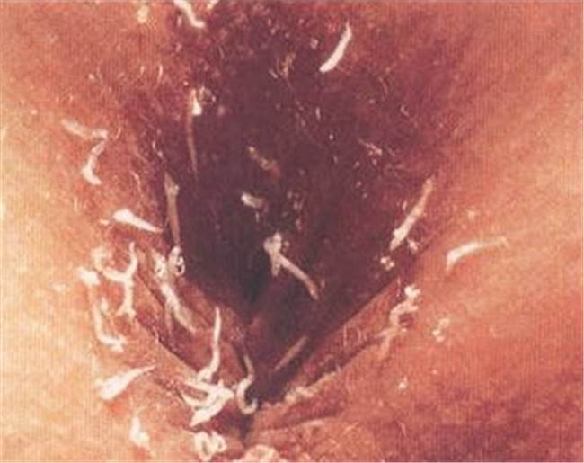 ▼ 蛲虫寄生患者的肛门,细白的小虫就是蛲虫.
