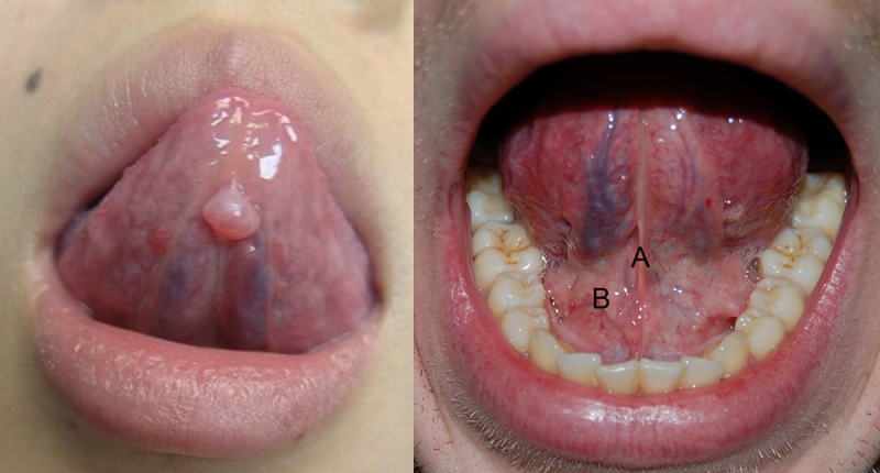 舌下「青筋」正常吗?一旦出现深青或暗紫色就代表著.