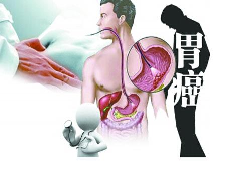 胃癌年輕化,6個早期信號不可忽視