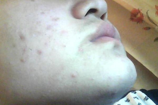 臉上持續出現這個,可別以為是自己變年輕了,而是該查血糖了