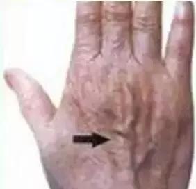 青筋凸起:痰、濕、瘀、毒積滯,不可不防!