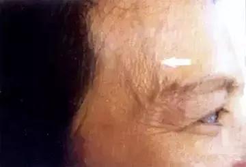 青筋凸起:痰、濕、瘀、毒積滯,不可不防!