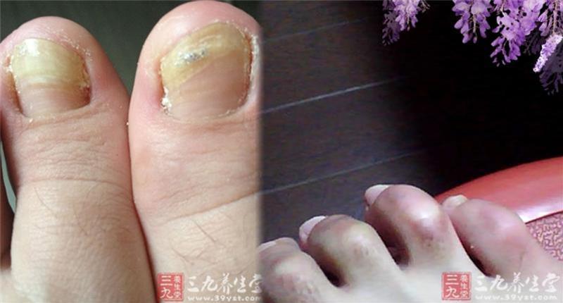 震驚!「腳指頭」如果長了這個東西…你就要特別小心了!可能是癌症前兆…