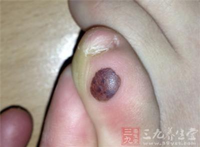 震驚!「腳指頭」如果長了這個東西…你就要特別小心了!可能是癌症前兆…