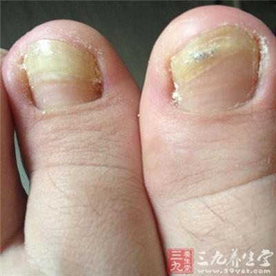 震驚!「腳指頭」如果長了這個東西…你就要特別小心了!可能是癌症前兆…