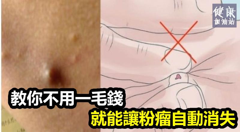 容易被忽略但一摸就很痛的「粉瘤」!