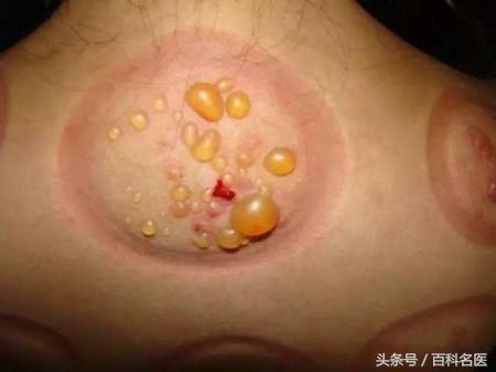 濕氣重的9大症狀,你中了幾個?中醫教你3招健脾祛濕