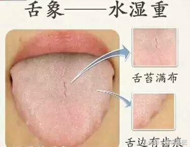 濕氣重的9大症狀,你中了幾個?中醫教你3招健脾祛濕